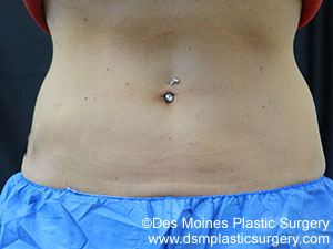 CoolSculpting Before and After Photo by Coachlight Clinic & Spa in West Des Moines Iowa