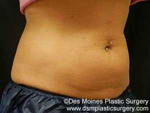 CoolSculpting Before and After Photo by Coachlight Clinic & Spa in West Des Moines Iowa