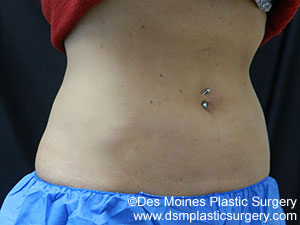 CoolSculpting Before and After Photo by Coachlight Clinic & Spa in West Des Moines Iowa