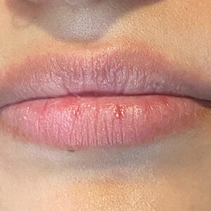 Lip Filler Before and After Photo by Coachlight Clinic & Spa in West Des Moines Iowa