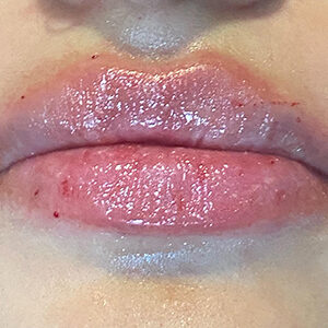 Lip Filler Before and After Photo by Coachlight Clinic & Spa in West Des Moines Iowa