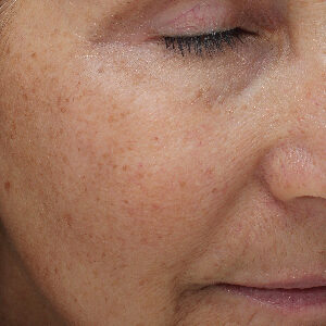 MOXI Before and After Photo by Coachlight Clinic & Spa in West Des Moines Iowa