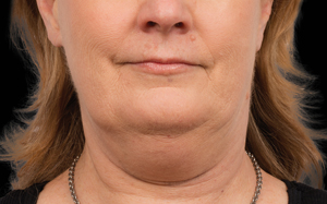 CoolSculpting Before and After Photo by Coachlight Clinic & Spa in West Des Moines Iowa