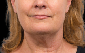 CoolSculpting Before and After Photo by Coachlight Clinic & Spa in West Des Moines Iowa