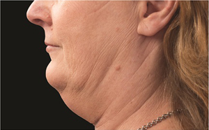 CoolSculpting Before and After Photo by Coachlight Clinic & Spa in West Des Moines Iowa