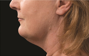 CoolSculpting Before and After Photo by Coachlight Clinic & Spa in West Des Moines Iowa