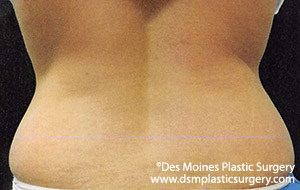 CoolSculpting Before and After Photo by Coachlight Clinic & Spa in West Des Moines Iowa