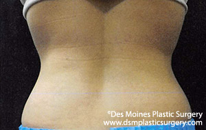 CoolSculpting Before and After Photo by Coachlight Clinic & Spa in West Des Moines Iowa
