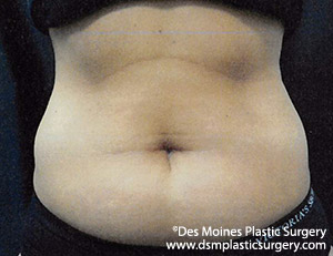 CoolSculpting Before and After Photo by Coachlight Clinic & Spa in West Des Moines Iowa