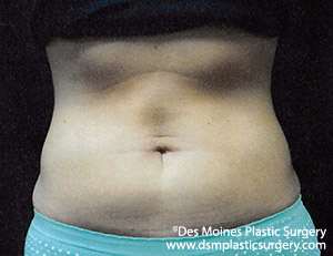 CoolSculpting Before and After Photo by Coachlight Clinic & Spa in West Des Moines Iowa