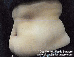 CoolSculpting Before and After Photo by Coachlight Clinic & Spa in West Des Moines Iowa