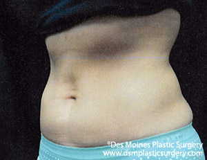 CoolSculpting Before and After Photo by Coachlight Clinic & Spa in West Des Moines Iowa
