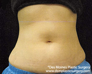 CoolSculpting Before and After Photo by Coachlight Clinic & Spa in West Des Moines Iowa