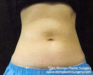 CoolSculpting Before and After Photo by Coachlight Clinic & Spa in West Des Moines Iowa