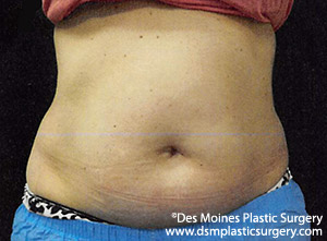 CoolSculpting Before and After Photo by Coachlight Clinic & Spa in West Des Moines Iowa