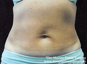 CoolSculpting Before and After Photo by Coachlight Clinic & Spa in West Des Moines Iowa
