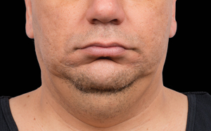 CoolSculpting Before and After Photo by Coachlight Clinic & Spa in West Des Moines Iowa