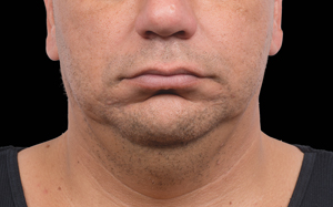 CoolSculpting Before and After Photo by Coachlight Clinic & Spa in West Des Moines Iowa