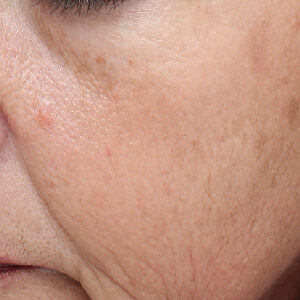 MOXI Before and After Photo by Coachlight Clinic & Spa in West Des Moines Iowa