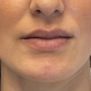 Lip Filler Before and After Photo by Coachlight Clinic & Spa in West Des Moines Iowa