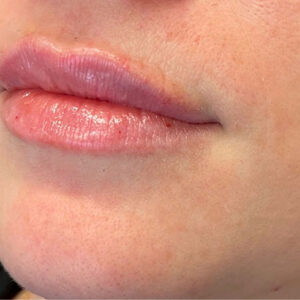 Lip Filler Before and After Photo by Coachlight Clinic & Spa in West Des Moines Iowa