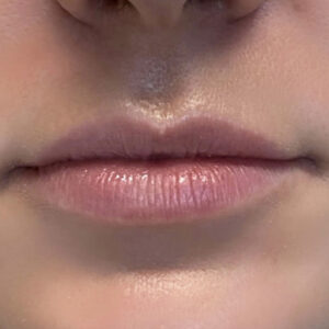 Lip Filler Before and After Photo by Coachlight Clinic & Spa in West Des Moines Iowa
