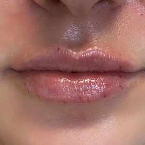 Lip Filler Before and After Photo by Coachlight Clinic & Spa in West Des Moines Iowa