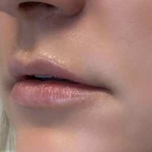 Lip Filler Before and After Photo by Coachlight Clinic & Spa in West Des Moines Iowa