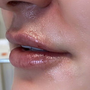 Lip Filler Before and After Photo by Coachlight Clinic & Spa in West Des Moines Iowa