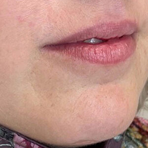 Lip Filler Before and After Photo by Coachlight Clinic & Spa in West Des Moines Iowa