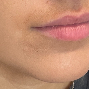 Lip Filler Before and After Photo by Coachlight Clinic & Spa in West Des Moines Iowa