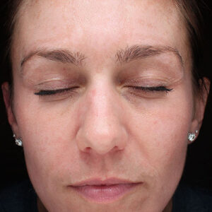 MOXI Before and After Photo by Coachlight Clinic & Spa in West Des Moines Iowa