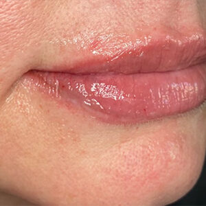 Lip Filler Before and After Photo by Coachlight Clinic & Spa in West Des Moines Iowa