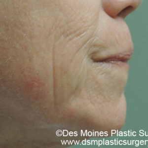 Laser Resurfacing Before and After Photo by Coachlight Clinic & Spa in West Des Moines Iowa