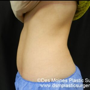 CoolSculpting Before and After Photo by Coachlight Clinic & Spa in West Des Moines Iowa