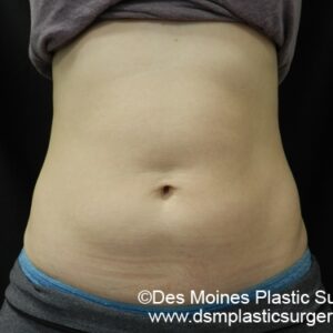 CoolSculpting Before and After Photo by Coachlight Clinic & Spa in West Des Moines Iowa