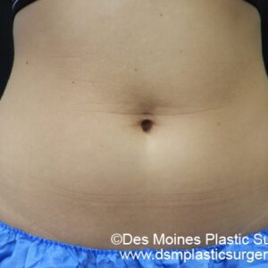 CoolSculpting Before and After Photo by Coachlight Clinic & Spa in West Des Moines Iowa