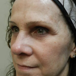 BBL® & BBL® HERO™ Before and After Photo by Coachlight Clinic & Spa in West Des Moines Iowa