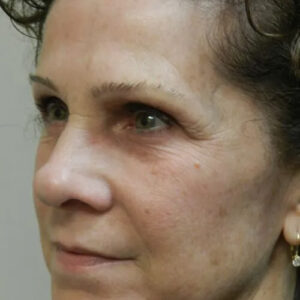 BBL® & BBL® HERO™ Before and After Photo by Coachlight Clinic & Spa in West Des Moines Iowa