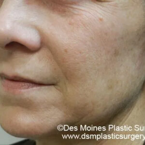 BBL® & BBL® HERO™ Before and After Photo by Coachlight Clinic & Spa in West Des Moines Iowa