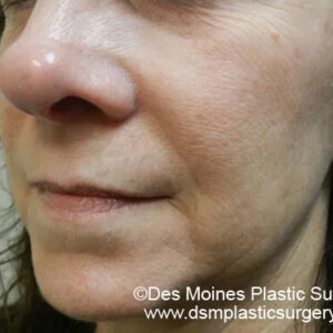 BBL® & BBL® HERO™ Before and After Photo by Coachlight Clinic & Spa in West Des Moines Iowa