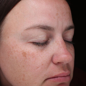 Halo treatment Before and After Photo by Coachlight Clinic Spa in West Des Moines Iowa