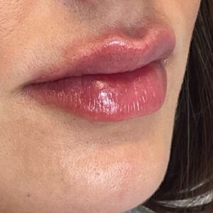 Lip Filler Before and After Photo by Coachlight Clinic & Spa in West Des Moines Iowa