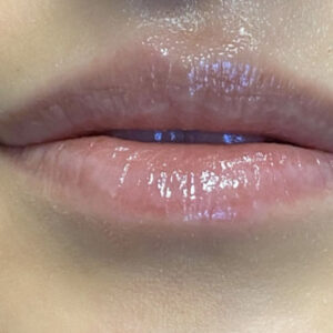 Lip Filler Before and After Photo by Coachlight Clinic & Spa in West Des Moines Iowa