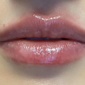 Lip Filler Before and After Photo by Coachlight Clinic & Spa in West Des Moines Iowa