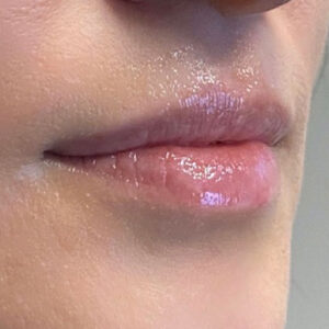 Lip Filler Before and After Photo by Coachlight Clinic & Spa in West Des Moines Iowa