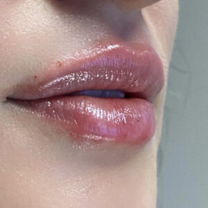 Lip Filler Before and After Photo by Coachlight Clinic & Spa in West Des Moines Iowa
