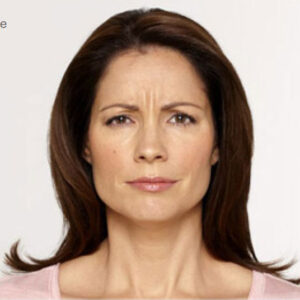 BOTOX Cosmetic® Before and After Photo by Coachlight Clinic & Spa in West Des Moines Iowa