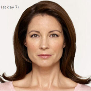 BOTOX Cosmetic® Before and After Photo by Coachlight Clinic & Spa in West Des Moines Iowa