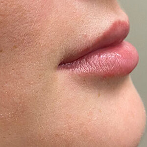 Lip Filler Before and After Photo by Coachlight Clinic & Spa in West Des Moines Iowa
